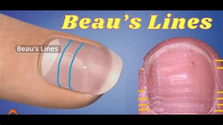 Beau's Lines: Uncover The Meaning Of Horizontal Nail Ridges