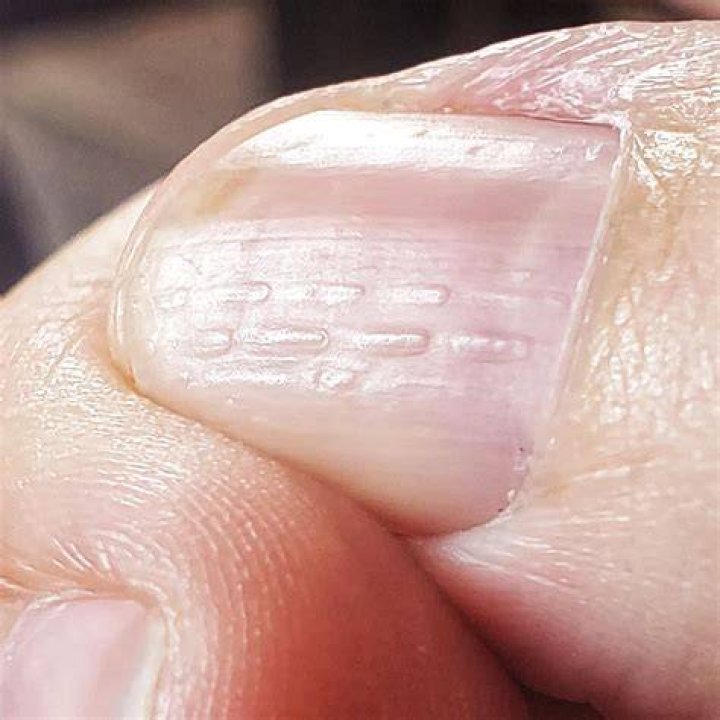 Discover The Meaning Behind Horizontal Nail Ridges: A Guide To Nail Health