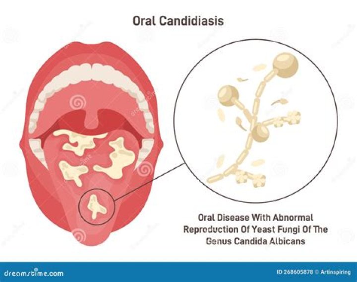 Do Bidets Really Cause Yeast Infections? The Truth Revealed