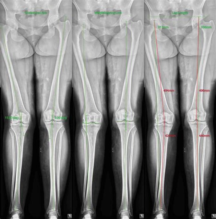 Optimal Leg To Height Ratio: The Ultimate Guide To Body Proportions