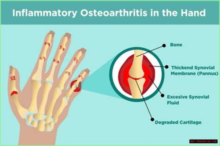 Understanding Hypertrophic Joints: Causes, Symptoms, And Treatment