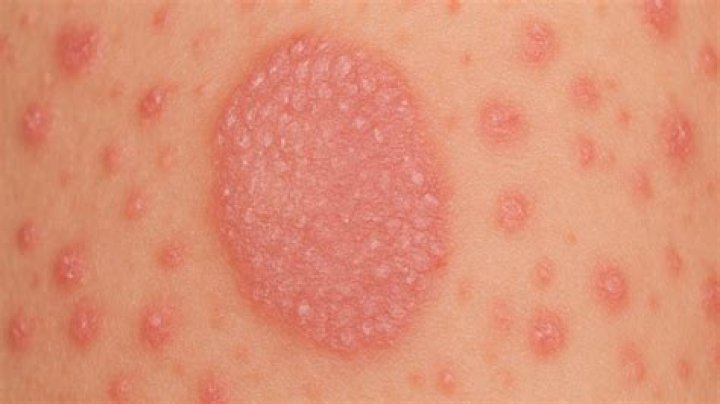 Unveiling The Duration Of Pityriasis Rosea: A Comprehensive Guide