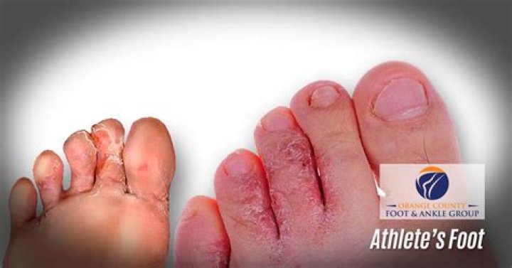 Warning: Athletes Foot And Hot Tubs: A Risky Combination