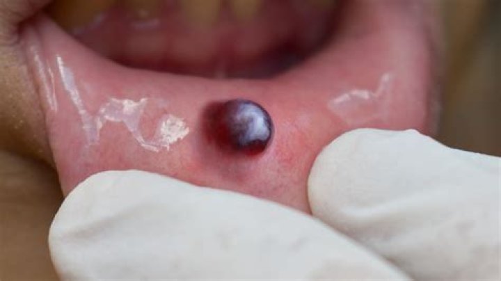 What Causes A Blood Blister On The Roof Of Your Mouth? Here's What You Need To Know